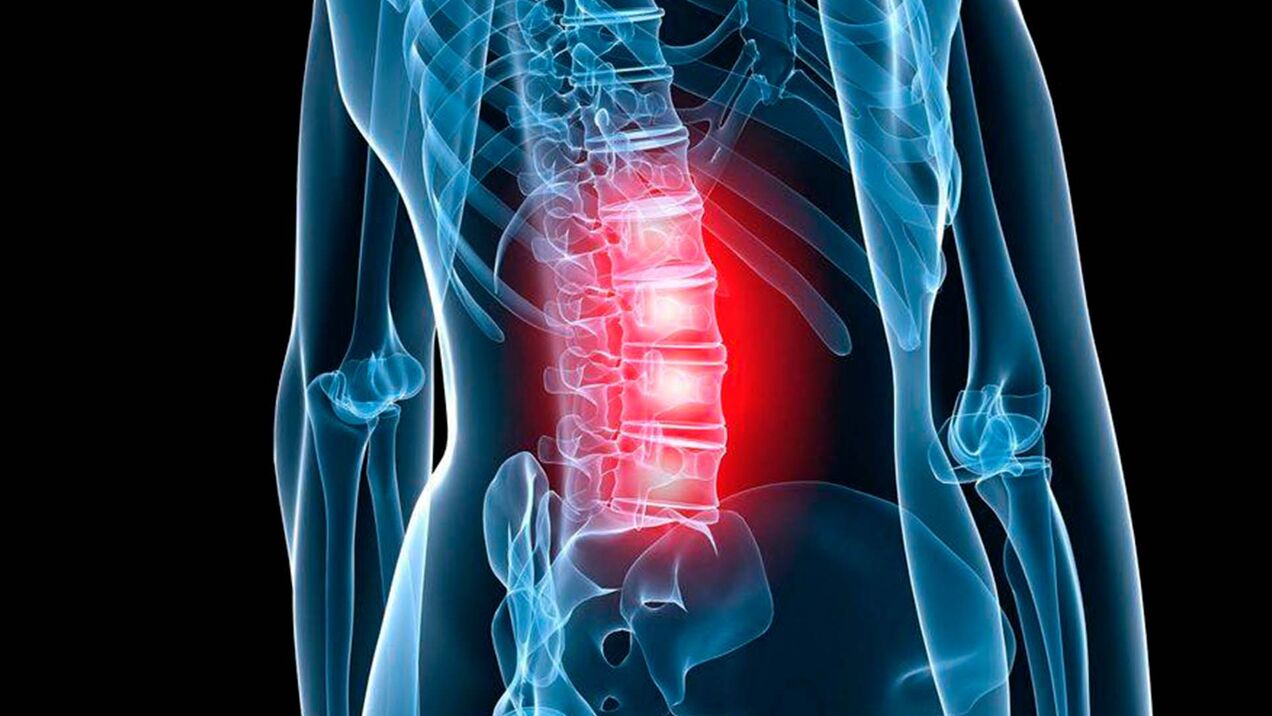 symptomen van lumbale osteochondrose