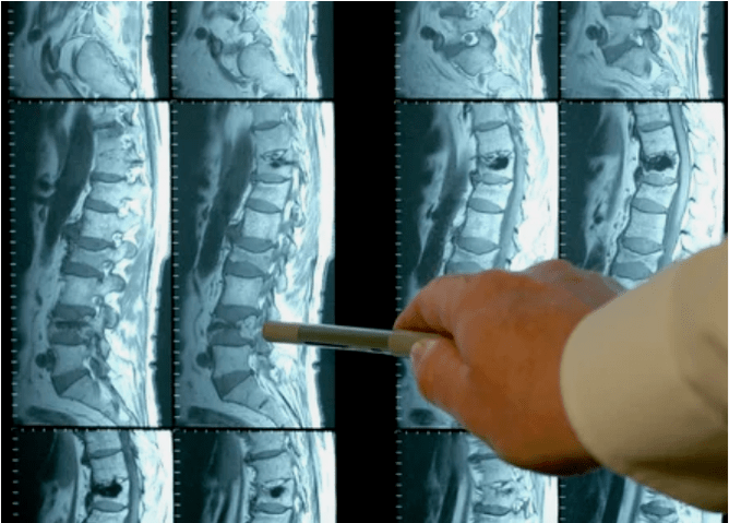 Variëteiten van osteochondrose in de wervelkolom