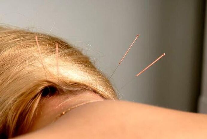 acupunctuur voor osteochondrose