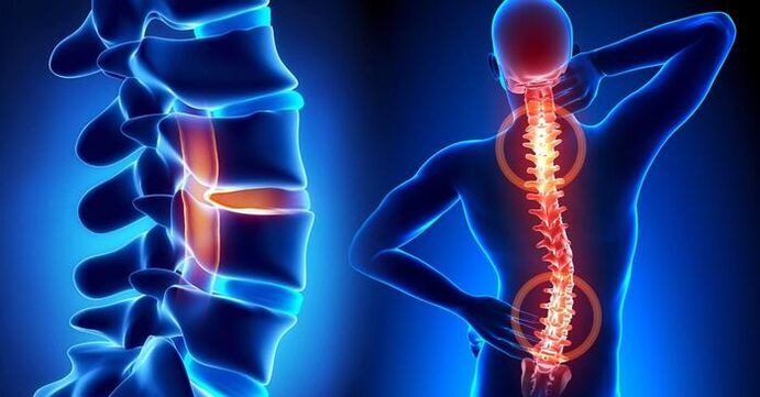 lokalisatie van pijn bij osteochondrose