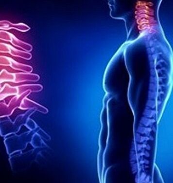Cervicale osteochondrose kan worden veroorzaakt door nekletsel