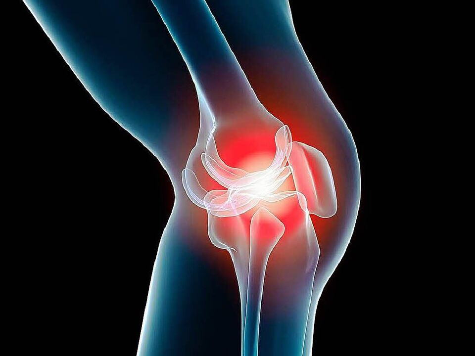artrose van de knie